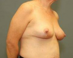 BREAST LIFT AFTER WEIGHT LOSS: Case 71 After